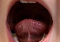 Krótkie wędzidełko - ankyloglosja grafika